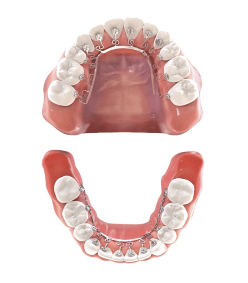 Brava Braces