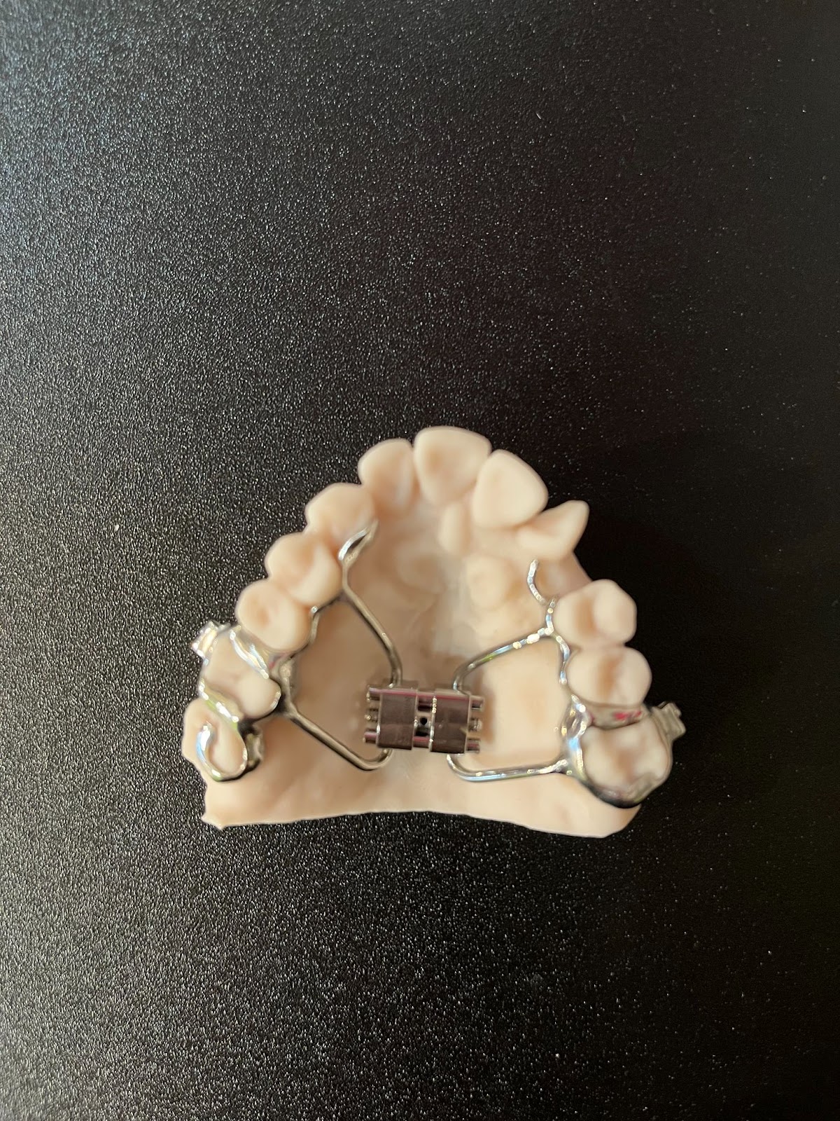 Does Your Child Need a Palatal Expander?