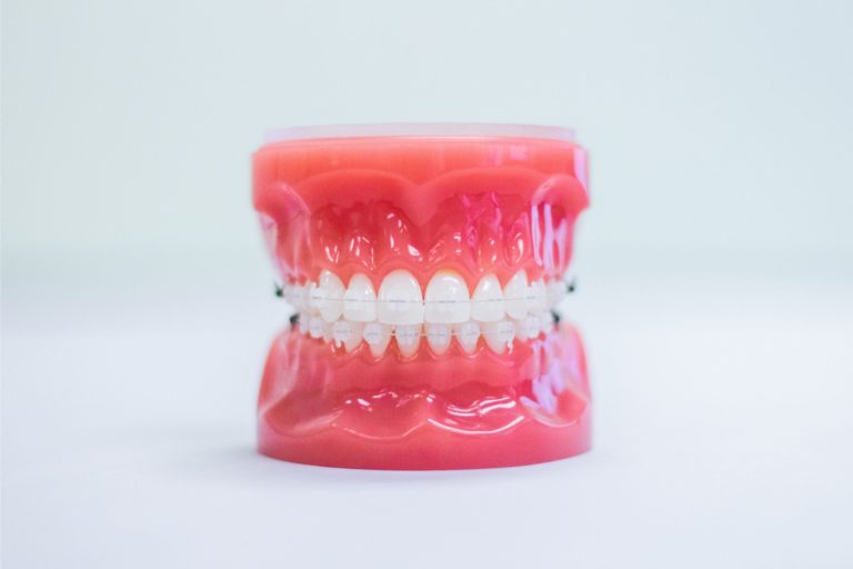 Model of teeth with clear braces demonstrating orthodontic treatment options at Braces by Dr. Ruth in Nashville, highlighting the effectiveness of clear braces for discreet teeth straightening.