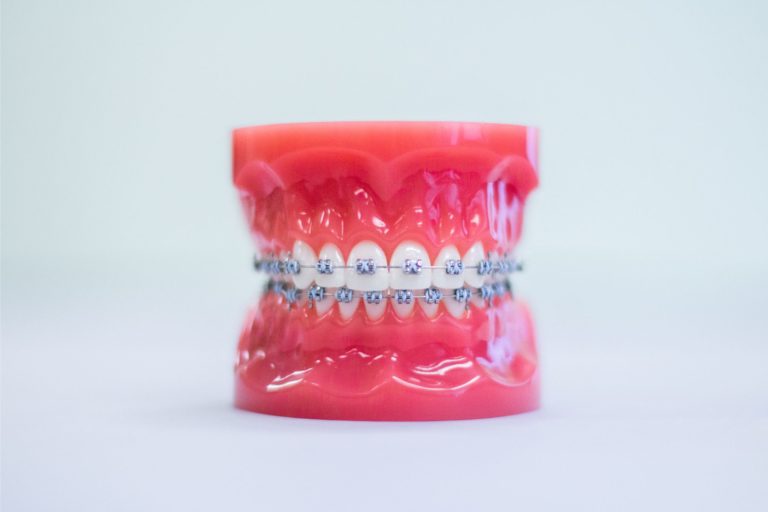 Model of teeth with traditional metal braces showcasing high-grade stainless steel brackets and archwires, illustrating orthodontic treatment options at Braces by Dr. Ruth in Nashville.